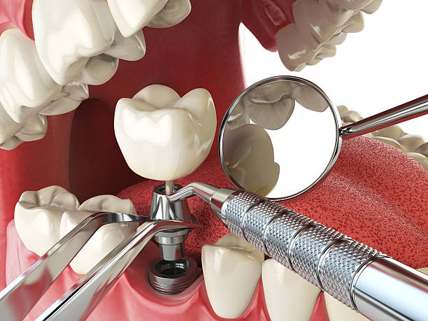 Best Emergency Root Canal Treatment in Bergenfield, NJ